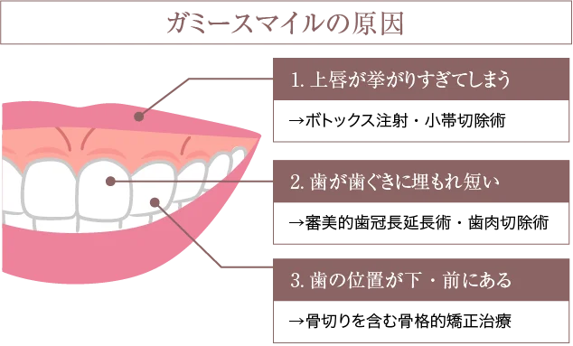 ガミースマイルの原因