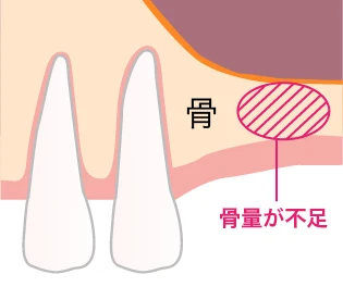 上顎の骨量が不足している