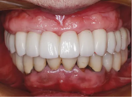 義歯装着患者に対する上顎のオールオン6によるインプラント治療 治療後
