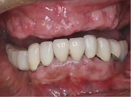 義歯装着患者に対する上顎のオールオン6によるインプラント治療 治療前
