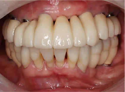重度歯周病患者に対する上顎のオールオン6によるインプラント治療 治療後