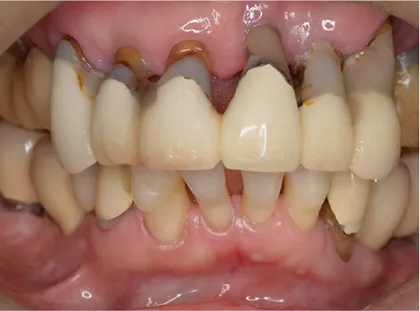 重度歯周病患者に対する上顎のオールオン6によるインプラント治療 治療前
