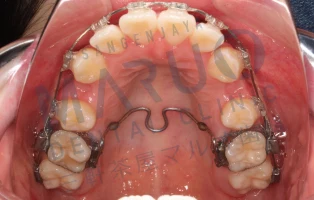 歯科矯正の治療例 治療中
