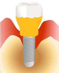インプラント周囲炎